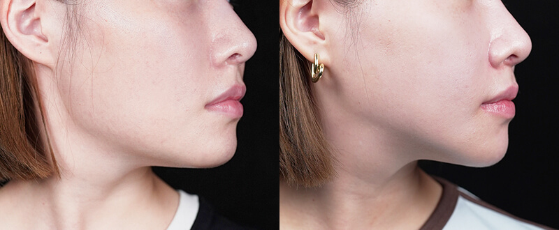 光澤診所3D立體骨雕案例5：法令紋改善與鼻基底填充