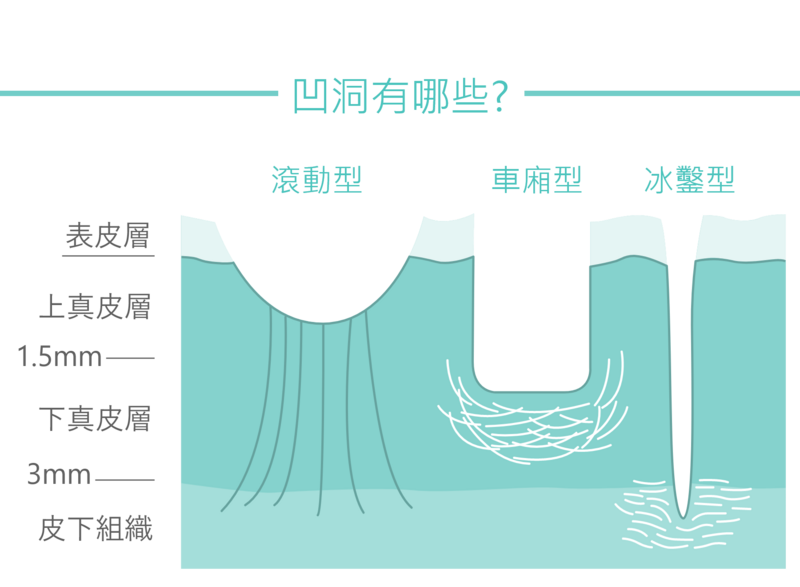 二代飛梭雷射可改善的凹痘疤/肌膚凹洞類型，分別為上真皮層的滾動型凹疤、深達下真皮層的車廂型凹疤以及深達皮下組織的冰鑿型凹疤。也可改善毛孔粗大、眼周/脖子細紋、妊娠紋或肥胖紋。