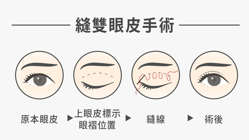 年紀較輕，沒有眼皮鬆弛下垂、眉毛與眼睛間距不寬的民眾，建議可以採用縫合方式來打造雙眼皮。