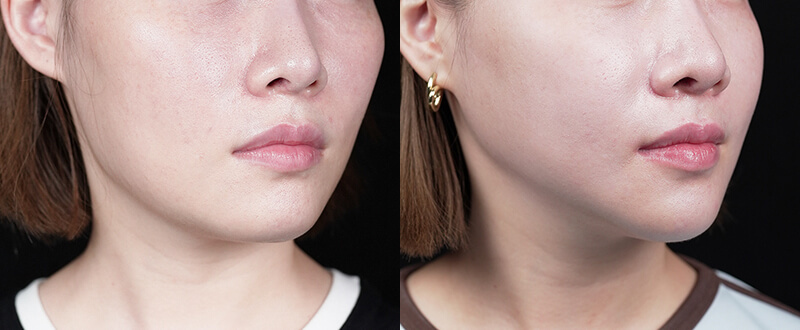 光澤診所3D立體骨雕案例6：全臉輪廓精雕