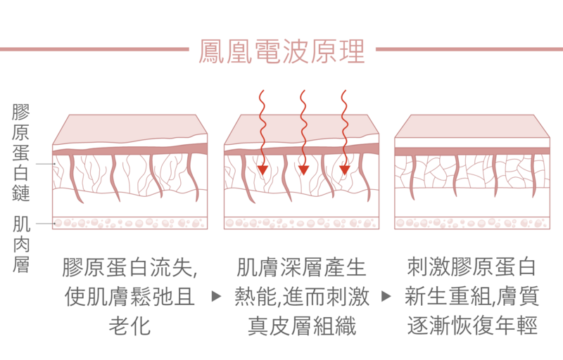 皮下的膠原蛋白流失，使肌膚鬆弛而有老化現象；而Thermage FLX鳳凰電波運用每秒振動約678萬次的高頻電波在皮膚形成電阻作用產生熱能，以3D 立體容積式加熱原理則能達到深層肌膚，精準深入到肌膚深達4.3mm並刺激真皮層組織，刺激膠原蛋白重組，讓膚質逐漸恢復年輕般的緊實與彈性。