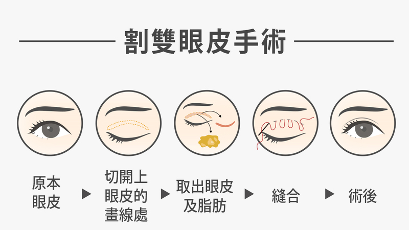 年紀較長、眼皮脂肪肥厚，或先天眼皮鬆弛、下垂者，且有大小眼困擾的者，則適合選擇用割的方式進行手術。
