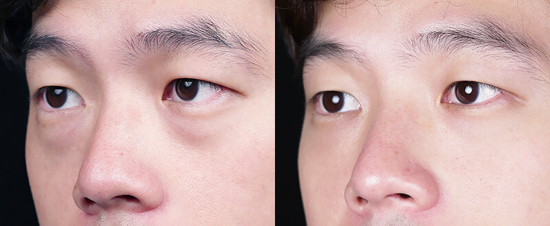 光澤診所5D亮睛術案例1：改善眼周細紋與淚溝凹陷