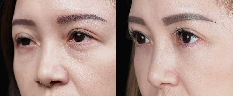 光澤診所5D亮睛術案例2：提亮眼周與改善黑眼圈