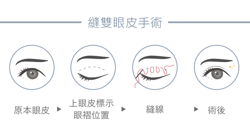 「縫雙眼皮」 以特殊縫線將眼皮縫到提眼肌筋膜或眼瞼板，穿入結膜再回頭穿出眼皮，把線結埋入皮下處；「釘書針雙眼皮」 以結合＂點與線＂之連續縫法將提眼瞼肌與眼瞼板眼皮連結在一起，進而產生雙眼皮。