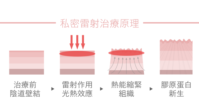 私密處雷射屬於非侵入式陰道緊實療程，利用360°環狀+90°垂直雷射技術，先溫和剝離老舊鬆弛組織，再進行溫熱治療，藉此促進上皮新生，膠原蛋白重組新生緊緻，帶動陰道壁血液循環與血管新生；和傳統的陰道手術相比，更不會有疼痛和修復期的困擾，有效改善老化及生產後造成的陰道鬆弛、乾澀問題。