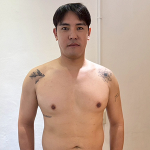 突破局部雕塑瓶頸：新一代酷塑冷凍減脂真實紀錄