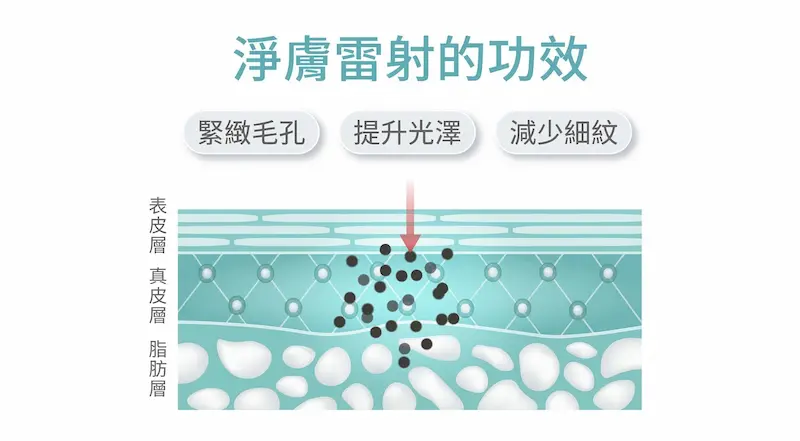 淨膚雷射通過促進膠原蛋白的增生，達到多種美容效果。