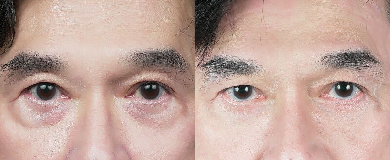 5D亮睛術術前術後對比-改善眼周老化與眼神無神