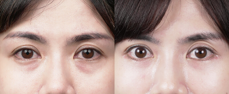 5D亮睛術術後對比-提亮眼神、解決疲累感