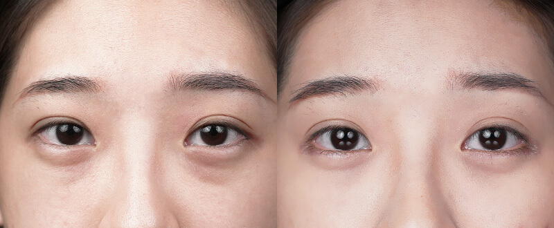 5D亮睛術臨床案例-全方位眼整形手術效果