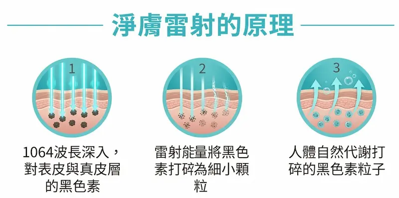 淨膚雷射三大核心功效