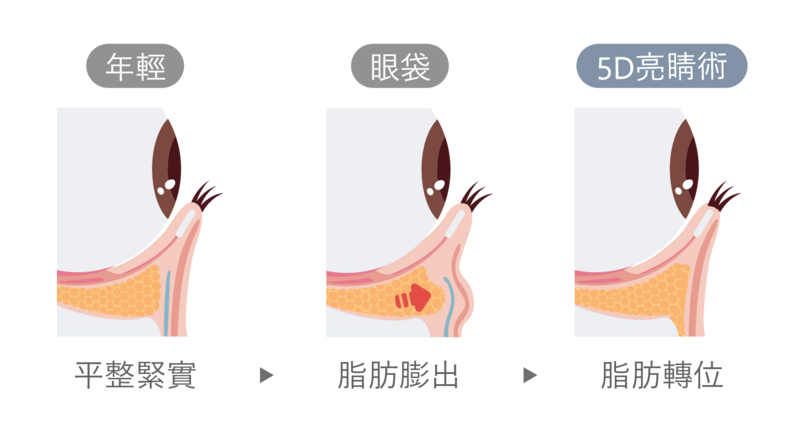 5D亮睛術透過打破框隔膜，自然引導脂肪能消除眼袋填補淚溝