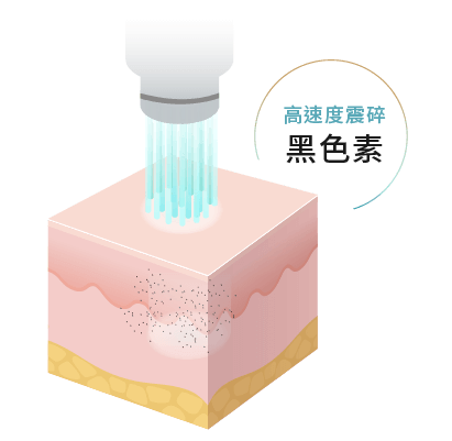 皮秒運用在雷射上即是採取超短脈衝的擊發速度，以光聲波震碎效應，低能量、高速度震碎黑色素，對於淡斑/除斑/祛班/肝斑等有顯著效果。